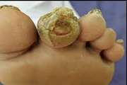 Footwear and offloading interventions to prevent and heal diabetic foot ulcers: Adapted IWGDF guidance