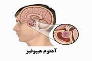 Empty sella in somatotropic pituitary adenomas a series of 23 cases