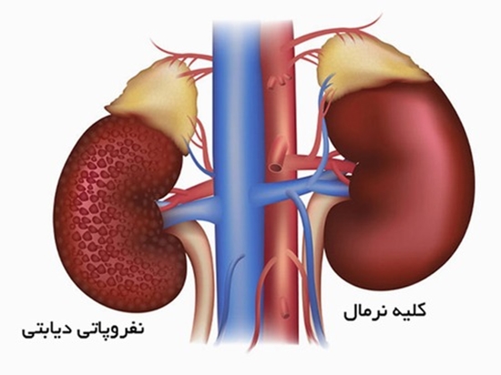نفروپاتی-دیابتی {faces}