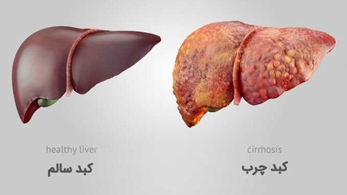 Regional fat distribution and hepatic fibrosis and steatosis severity in patients with nonalcoholic fatty liver disease and type 2 diabetes