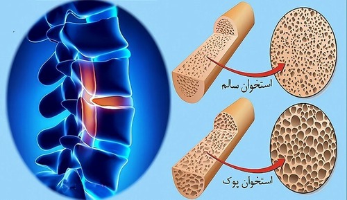 6 شکستگی لگن در هر ساعت براثر پوکی استخوان درکشور رخ می دهد