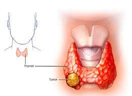 سرطان هرتل سل تیروئید