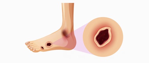 Epidemiological Insights into Diabetic Foot Amputation and its Correlates: A Provincial Study