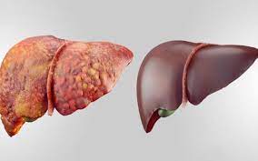 Factors related to hypermetabolism in individuals with type 2 diabetes mellitus and non-alcoholic fatty liver disease