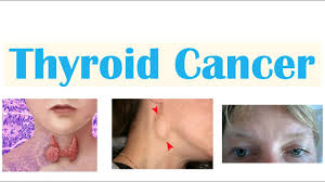 Thyroid Cancer research at endocrinology and metabolism research institute (EMRI) a report of scientific activities between 2005 and 2020