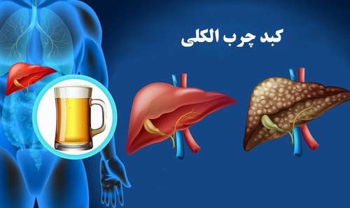 پژوهشی نوآورانه در پژوهشگاه علوم غدد و متابولیسم: پروفایل اسیدهای آمینه به عنوان بیومارکری برای تشخیص و پیش‌بینی شدت بیماری کبد چرب غیر الکلی