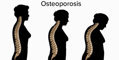نیمی از زنان بالای 50 سال دچار پوکی استخوان هستند