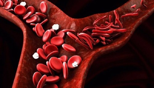 How Age, Sex and Transfusion Affects the Incidence of Endocrine and Bone Density Disorders in Major Thalassemic Patients