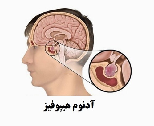 Empty sella in somatotropic pituitary adenomas a series of 23 cases