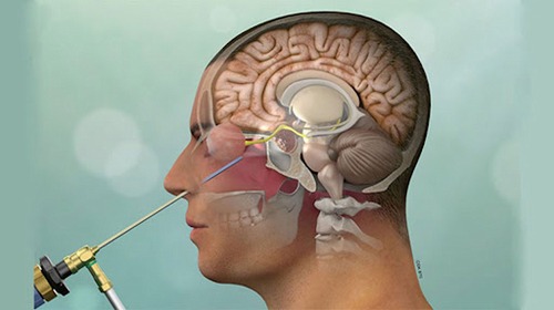 Assessment of the initial results of pituitary tumor registry at a tertiary hospital of Iran 2009-2022