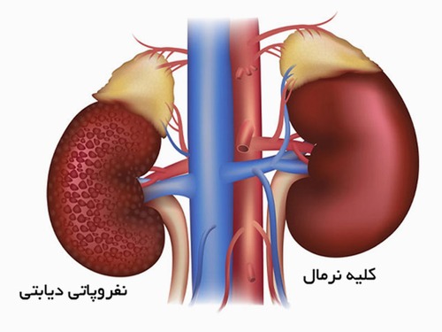 Correction: Association of cardiovascular risk factors with diabetic kidney disease severity in the Iranian population