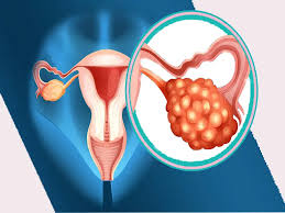 Recommendation to evaluate thyroid function in patients with polycystic ovary syndrome (PCOS)