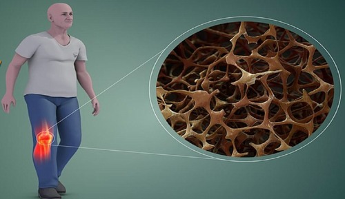 Association between serum hemoglobin level and bone mineral density in adults: Iranian multi-center osteoporosis study (IMOS)