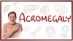 Predictors of biochemical and structural response to medical therapy in patients with active acromegaly following surgery: a real-world perspective